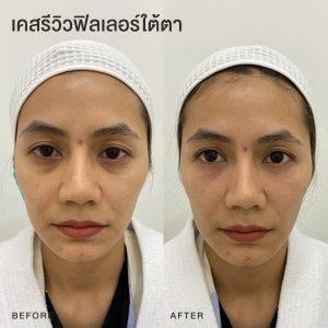 รีวิวฟิลเลอร์ใต้ตา หมอโบ