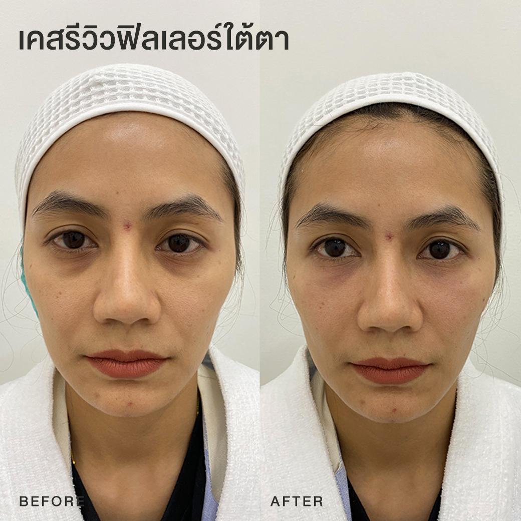 รีวิวฟิลเลอร์ใต้ตา หมอโบ