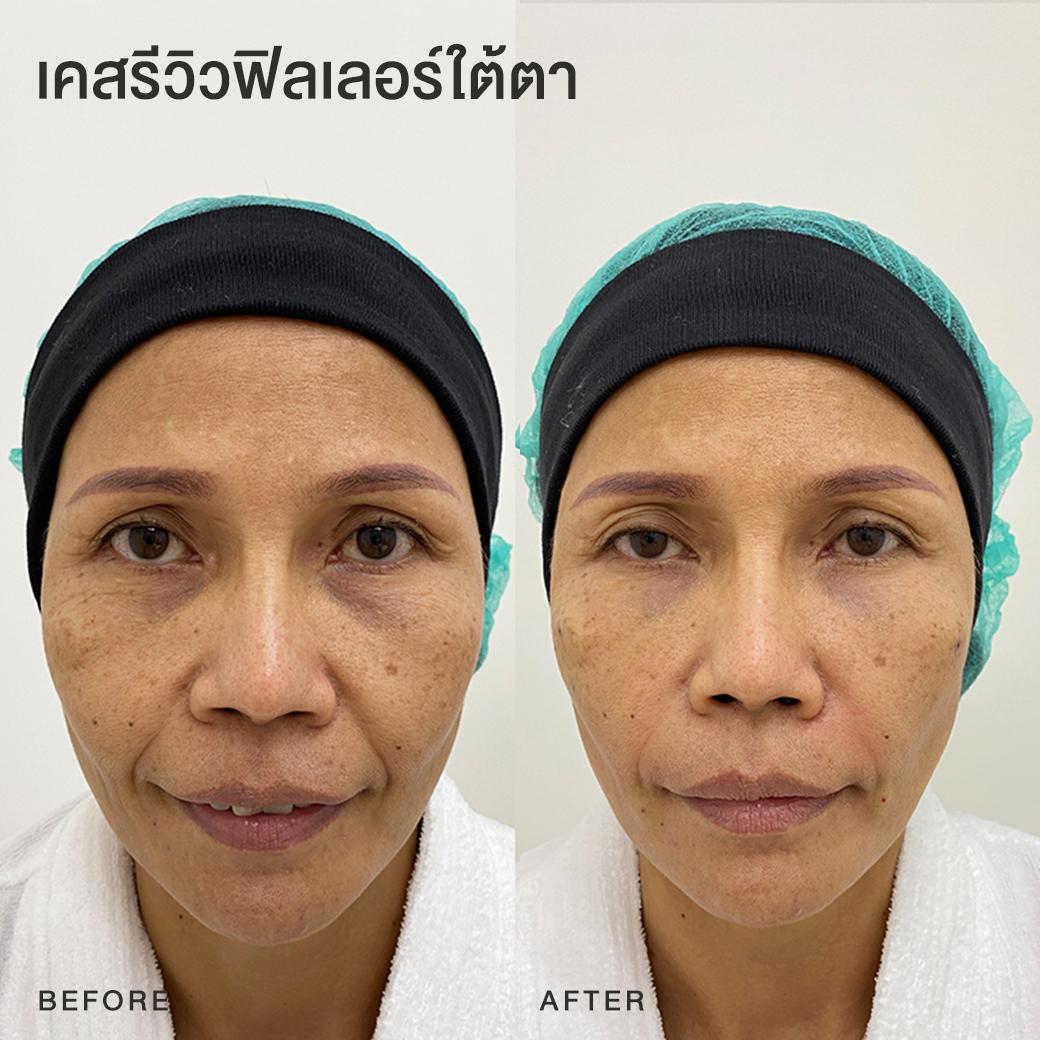 รีวิวฟิลเลอร์ใต้ตา หมอโบ