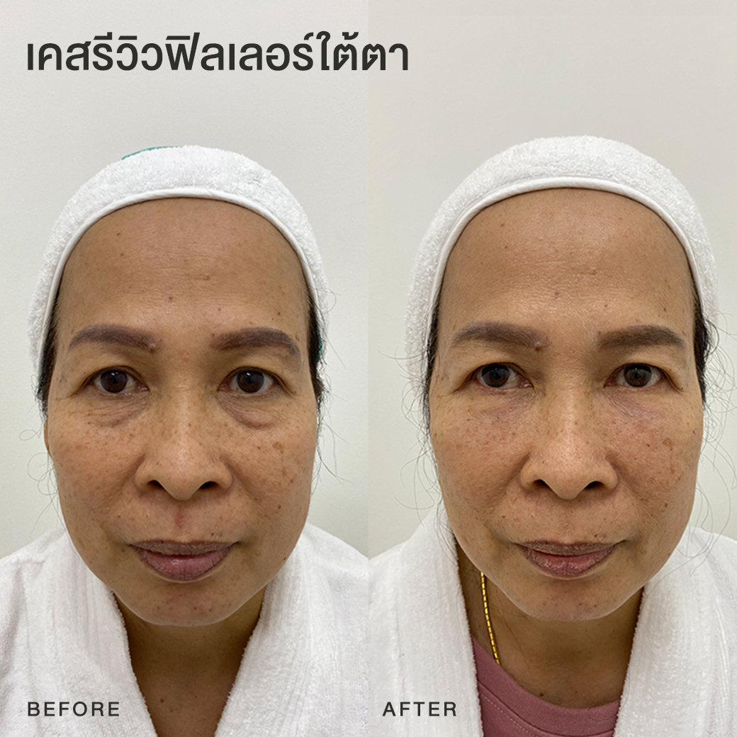 รีวิวฟิลเลอร์ใต้ตา หมอโบ