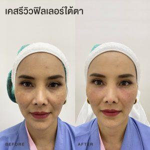 รีวิวฟิลเลอร์ใต้ตา หมอโบ