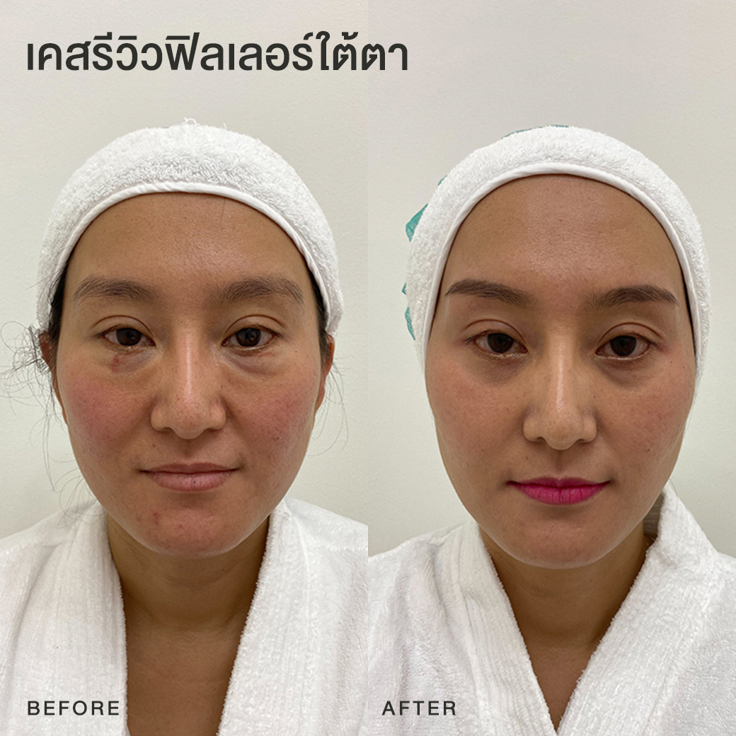 รีวิวฟิลเลอร์ใต้ตา หมอโบ