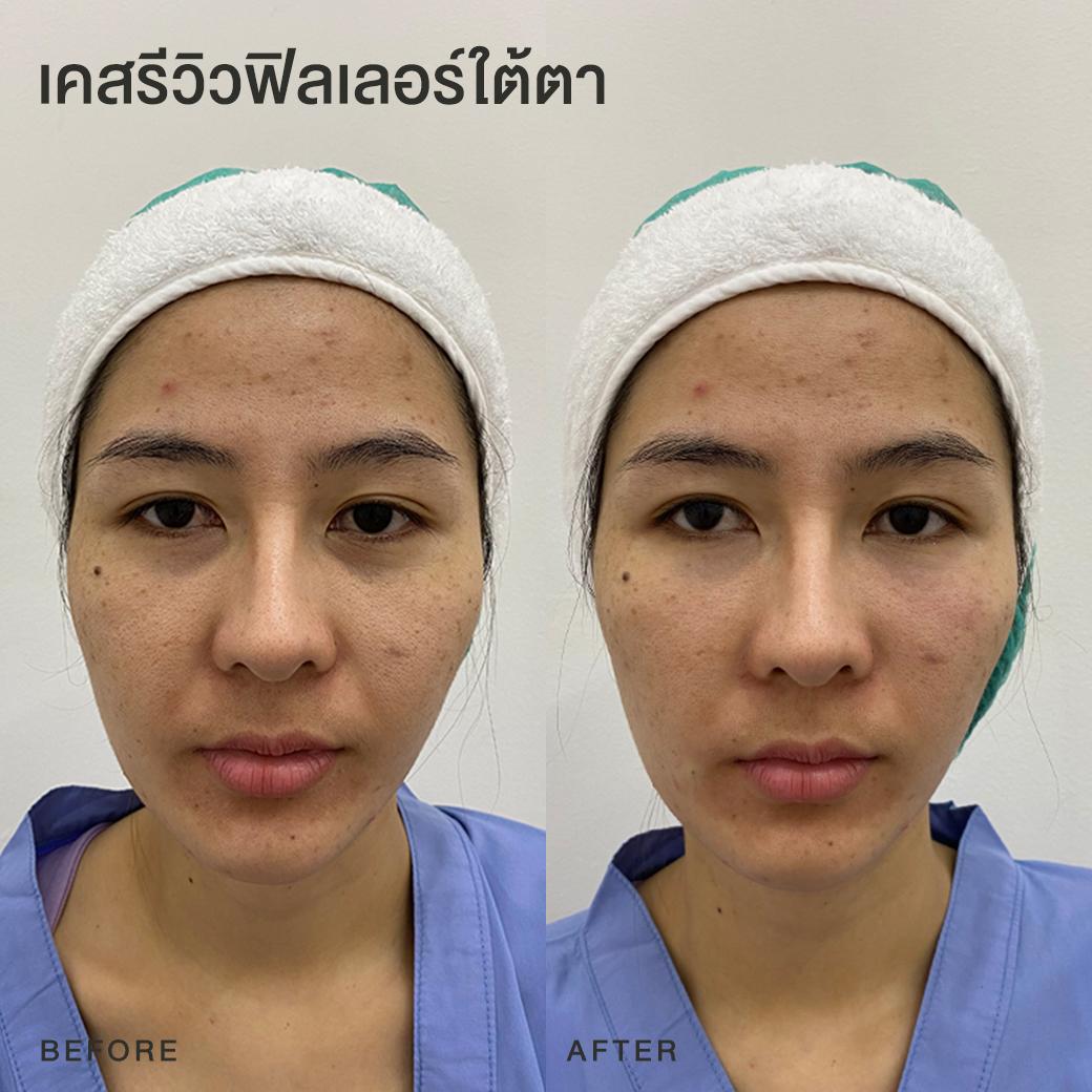 รีวิวฟิลเลอร์ใต้ตา หมอโบ