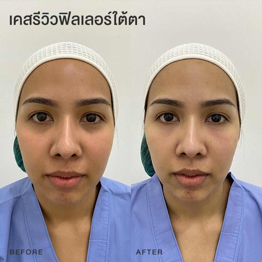 รีวิวฟิลเลอร์ใต้ตา หมอโบ