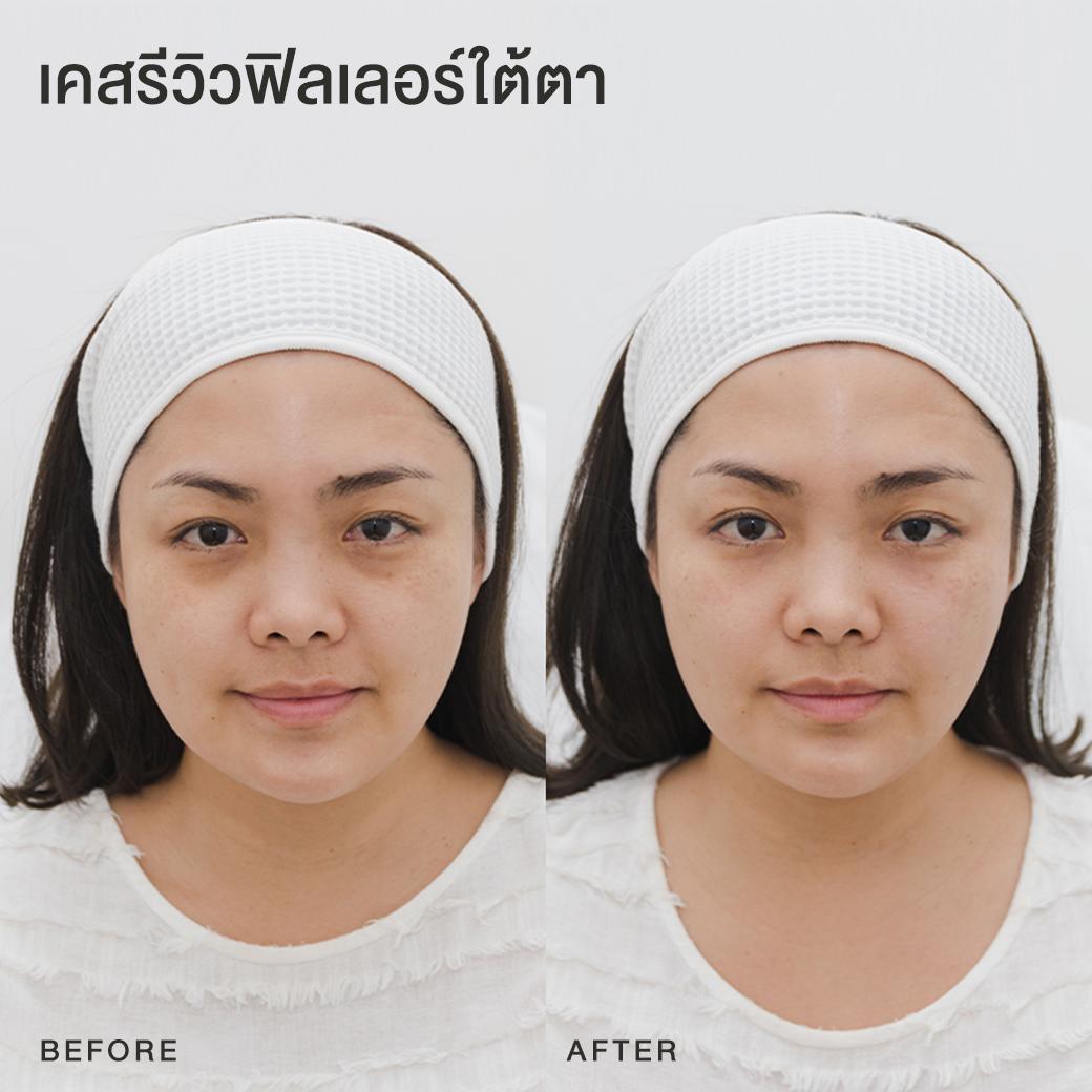 รีวิวฟิลเลอร์ใต้ตา หมอโบ