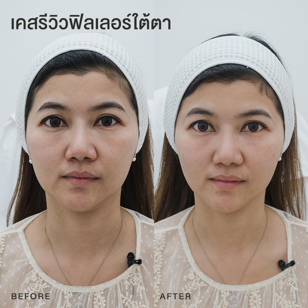 รีวิวฟิลเลอร์ใต้ตา หมอโบ