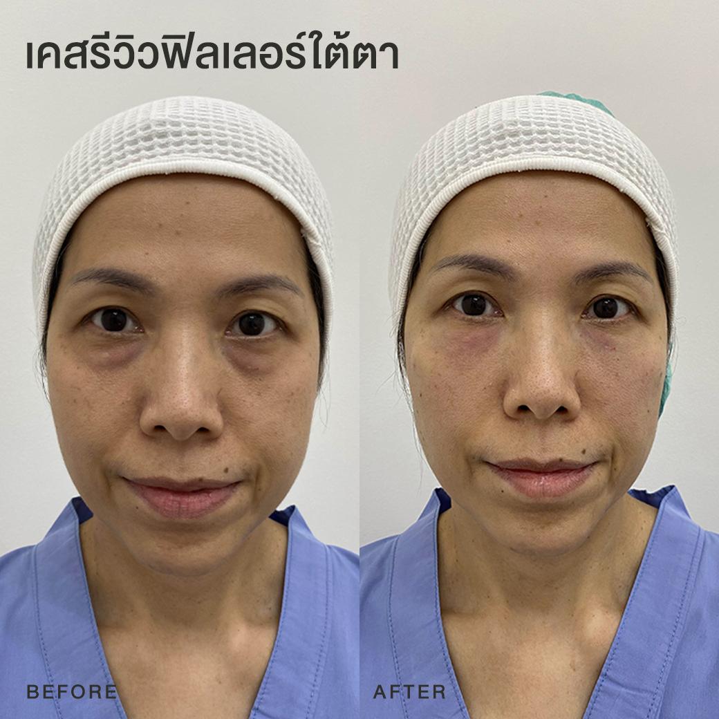 รีวิวฟิลเลอร์ใต้ตา หมอโบ