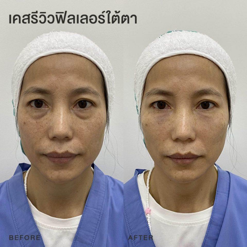 รีวิวฟิลเลอร์ใต้ตา หมอโบ