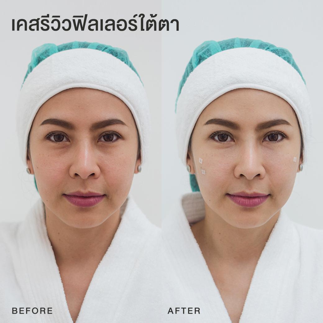 รีวิวฟิลเลอร์ใต้ตา หมอโบ