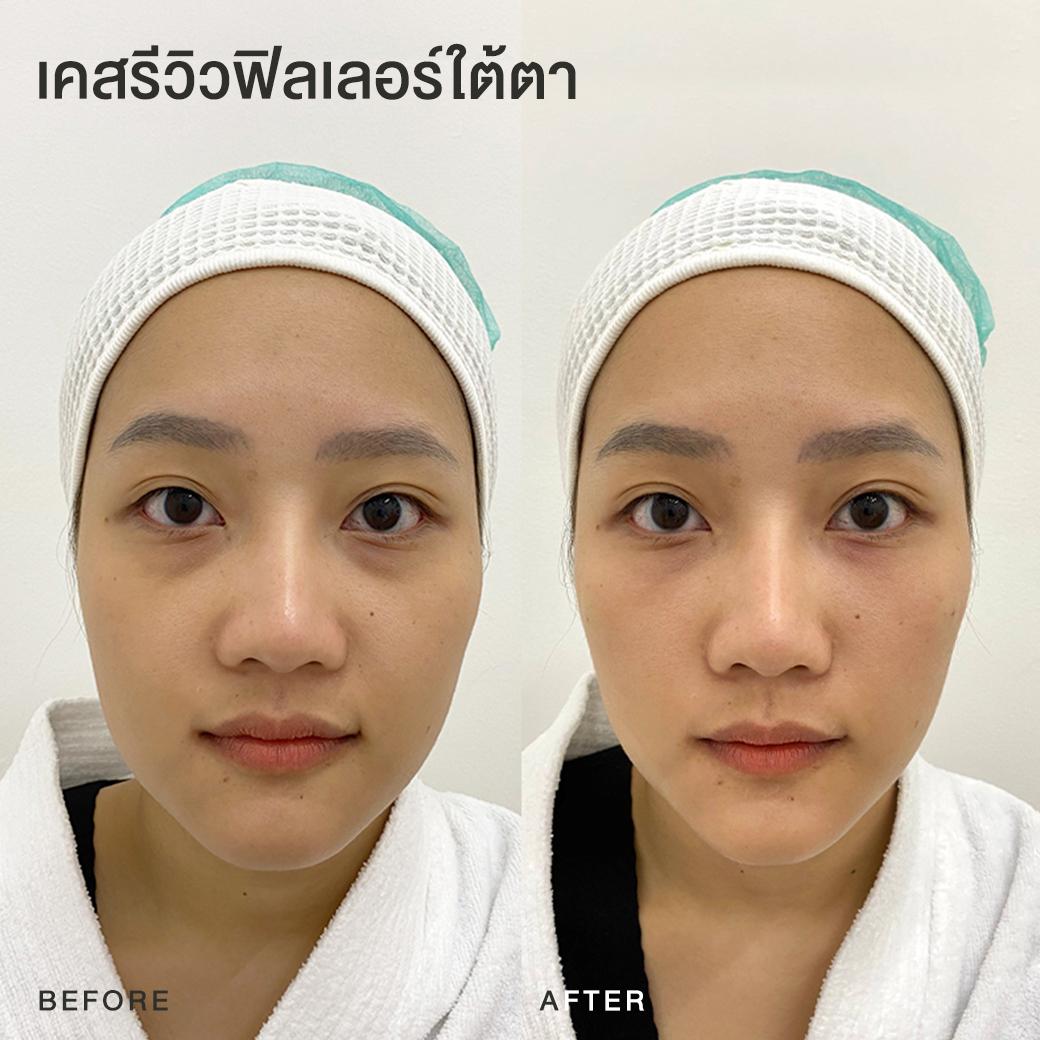 รีวิวฟิลเลอร์ใต้ตา หมอโบ