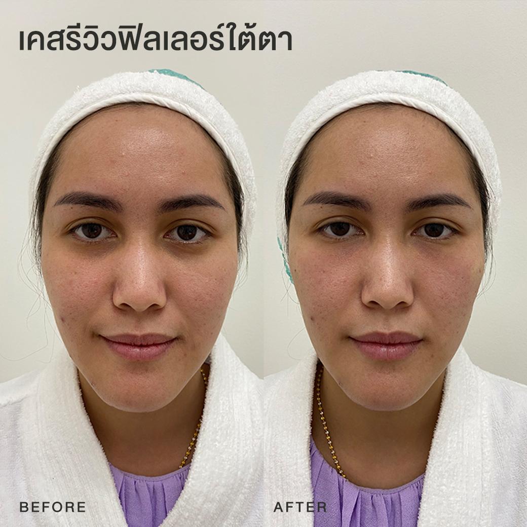 รีวิวฟิลเลอร์ใต้ตา หมอโบ