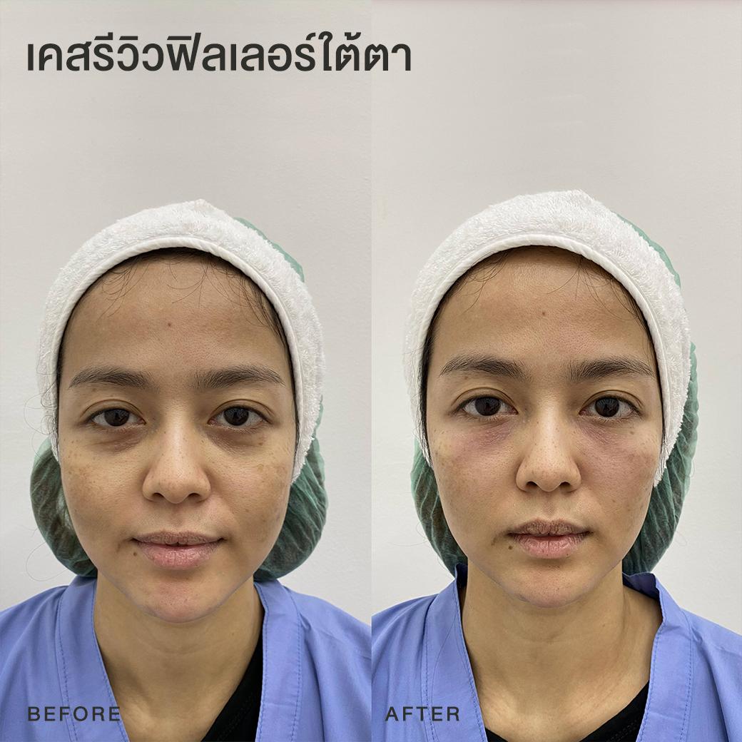 รีวิวฟิลเลอร์ใต้ตา หมอโบ