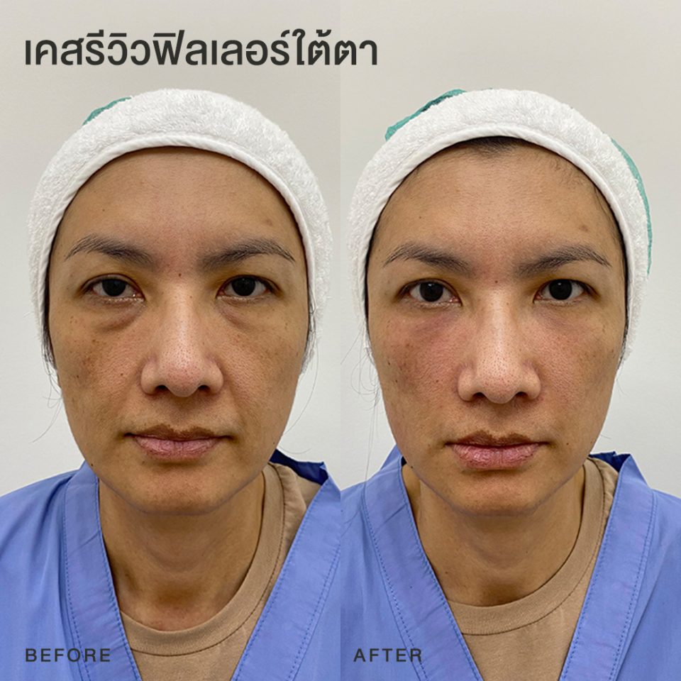 รีวิวฟิลเลอร์ใต้ตา หมอโบ