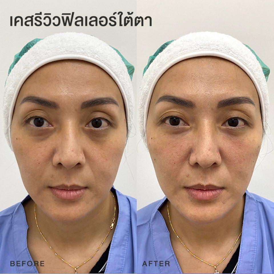 รีวิวฟิลเลอร์ใต้ตา หมอโบ