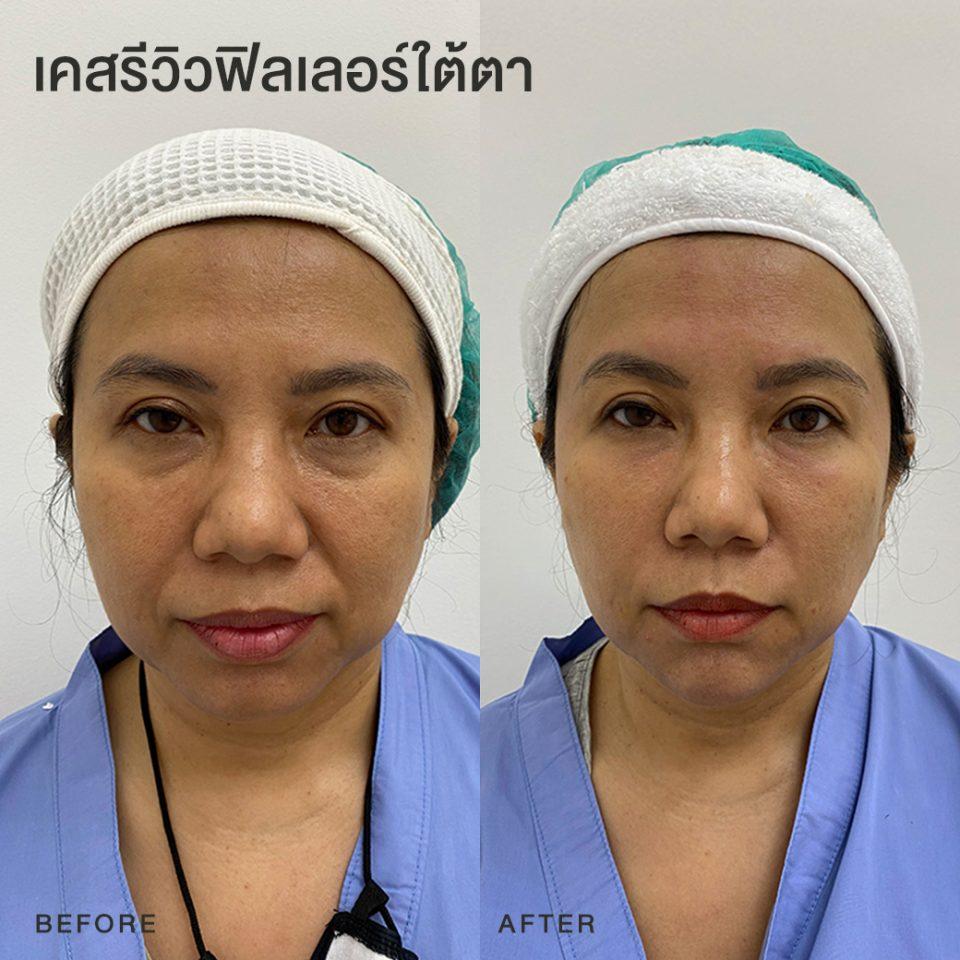 รีวิวฟิลเลอร์ใต้ตา หมอโบ