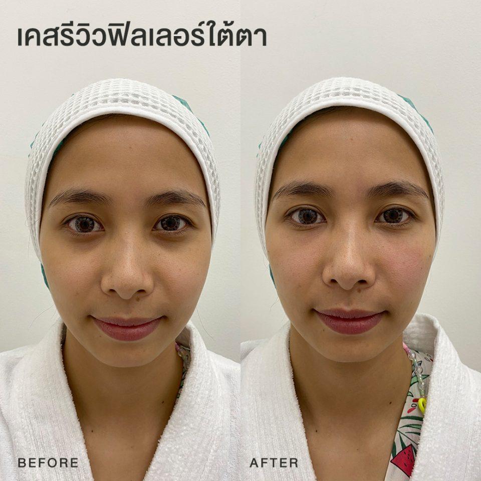 รีวิวฟิลเลอร์ใต้ตา หมอโบ