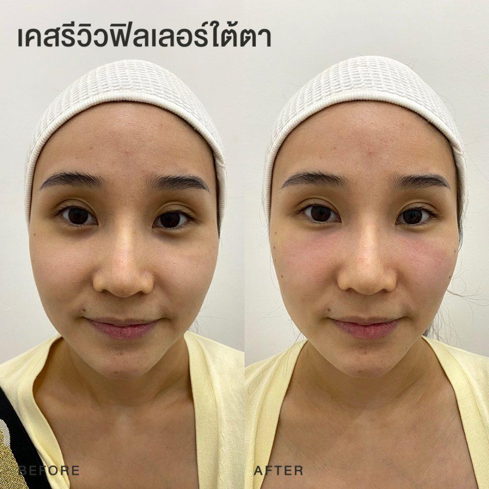 รีวิวฟิลเลอร์ใต้ตา หมอโบ