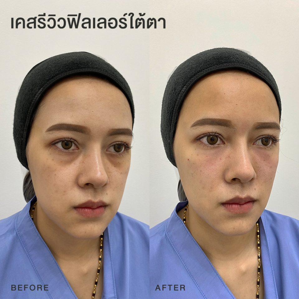 รีวิวฟิลเลอร์ใต้ตา หมอโบ