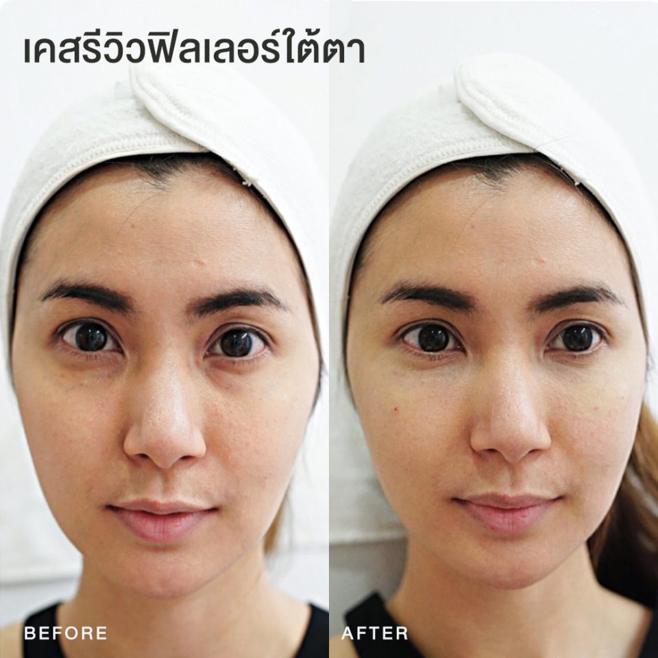 รีวิวฟิลเลอร์ใต้ตา หมอโบ