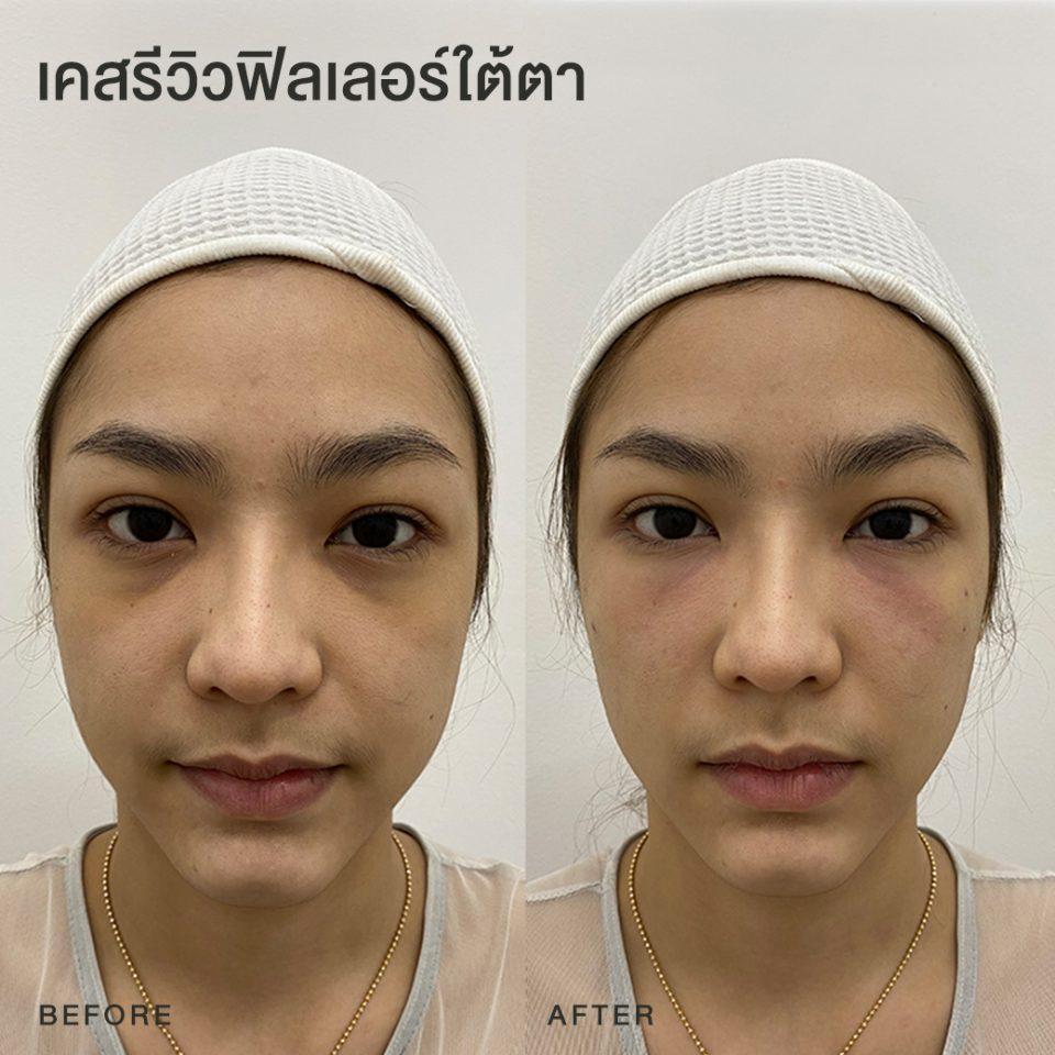 รีวิวฟิลเลอร์ใต้ตา หมอโบ