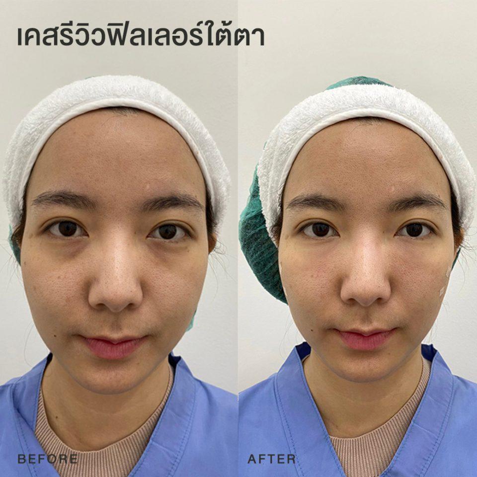 รีวิวฟิลเลอร์ใต้ตา หมอโบ