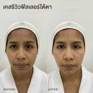 รีวิวฟิลเลอร์ใต้ตา หมอโบ