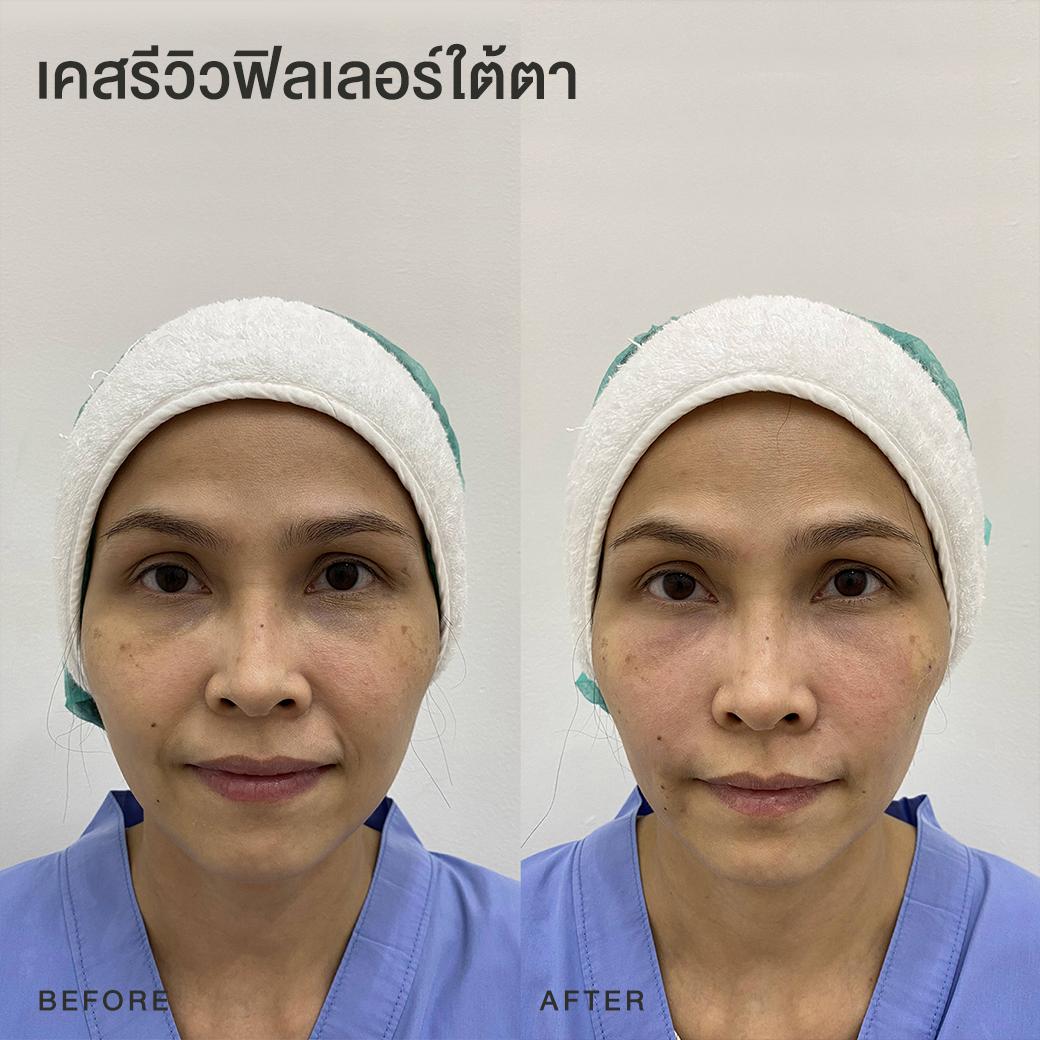 รีวิวฟิลเลอร์ใต้ตา หมอโบ