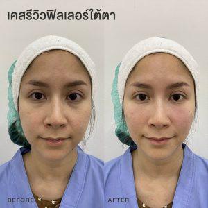 รีวิวฟิลเลอร์ใต้ตา หมอโบ