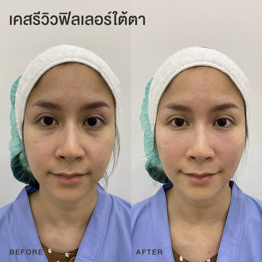 รีวิวฟิลเลอร์ใต้ตา หมอโบ