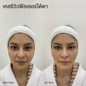 รีวิวฟิลเลอร์ใต้ตา หมอโบ