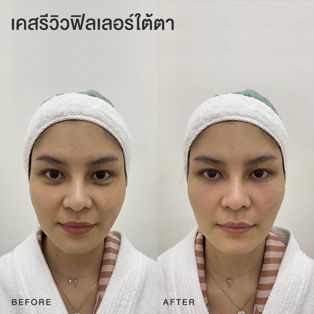 รีวิวฟิลเลอร์ใต้ตา หมอโบ