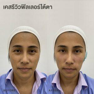 รีวิวฟิลเลอร์ใต้ตา หมอโบ
