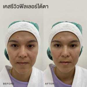 รีวิวฟิลเลอร์ใต้ตา หมอโบ