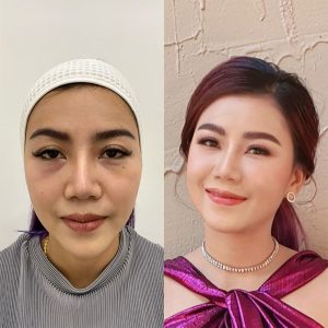 ฉีดฟิลเลอร์ใต้ตา เป็นก้อน เป็นลำ