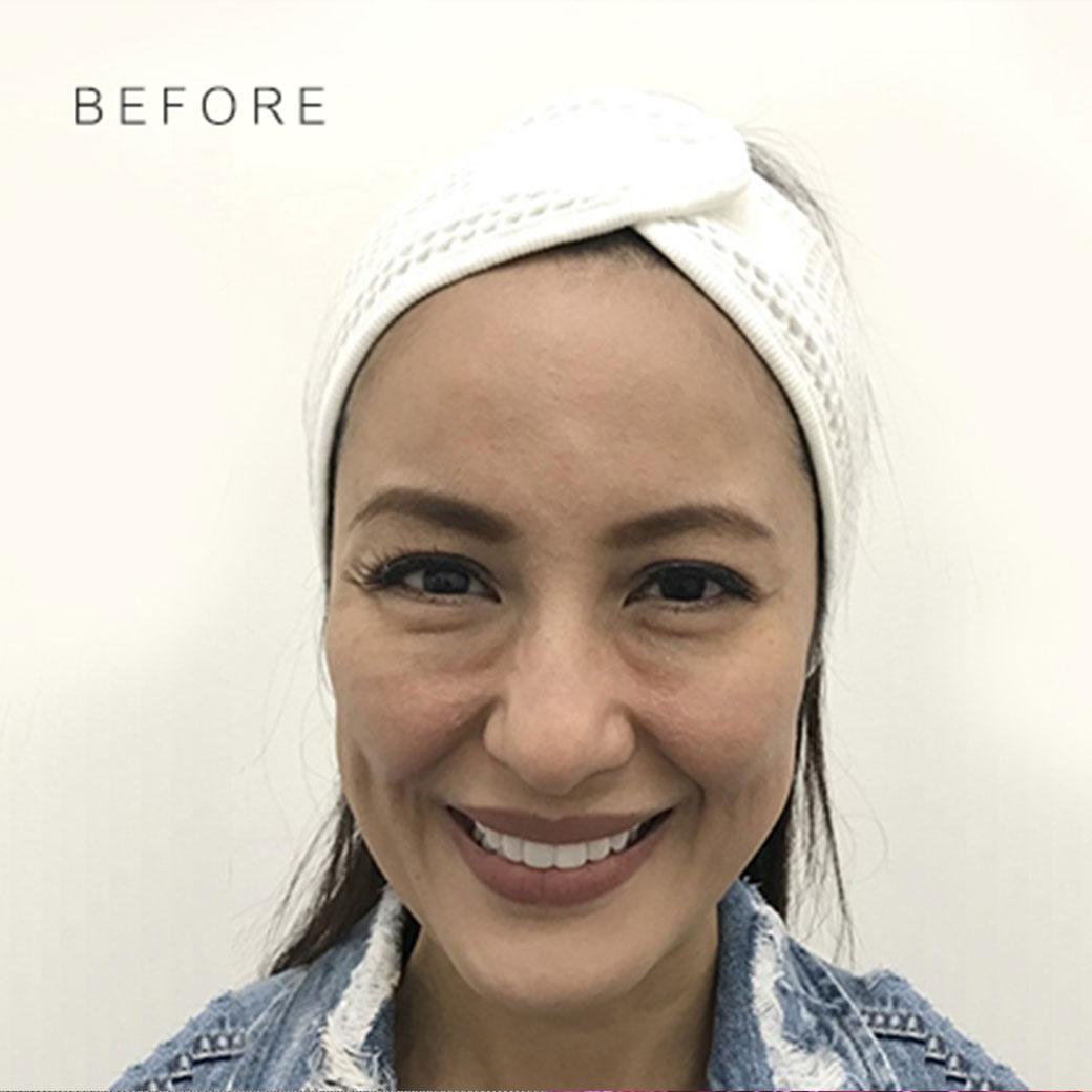 ฉีดฟิลเลอร์ใต้ตา เป็นก้อน เป็นลำ