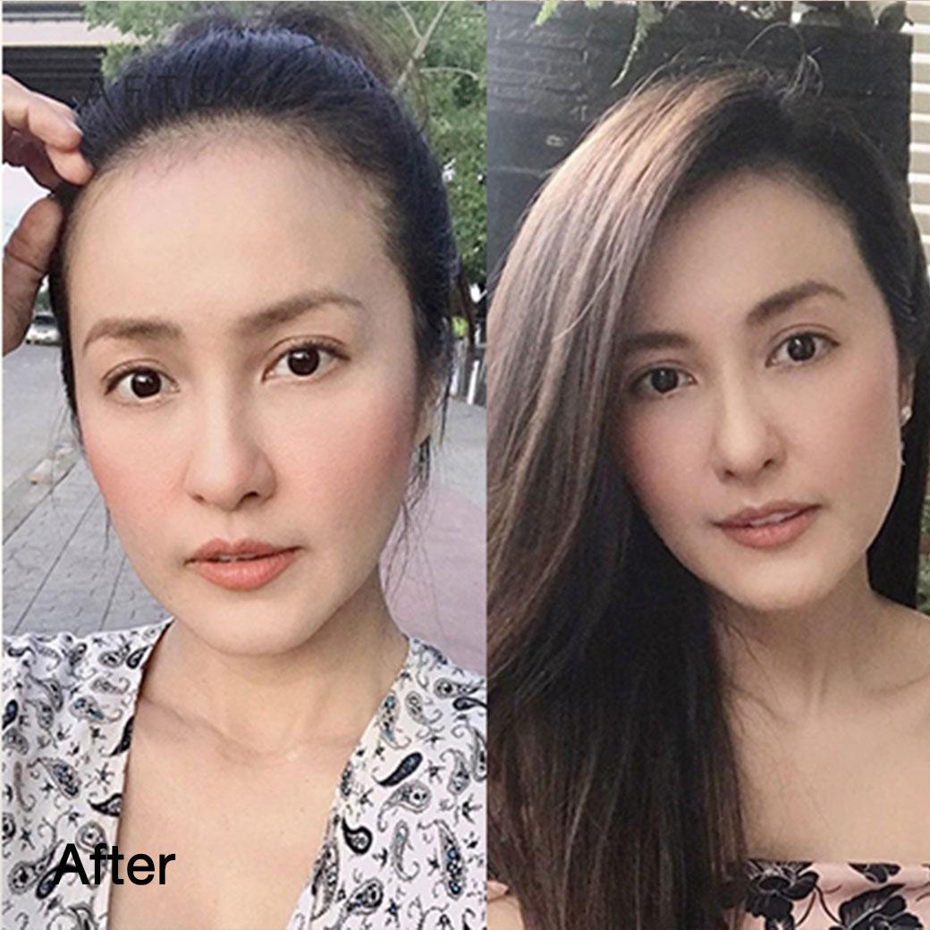 ฉีดฟิลเลอร์ใต้ตา เป็นก้อน เป็นลำ