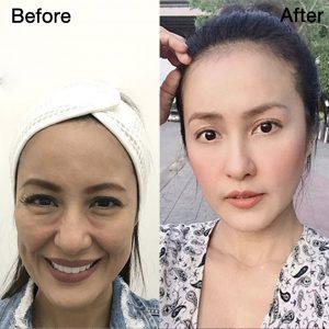 ฉีดฟิลเลอร์ใต้ตา เป็นก้อน เป็นลำ