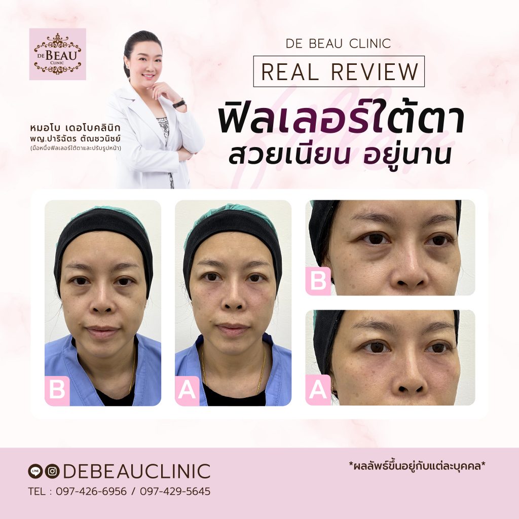 รีวิวฟิลเลอร์ใต้ตา หมอโบ เดอโบคลินิก