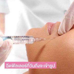 ฉีดฟิลเลอร์กี่วันเข้าที่ กี่วันถึงจะเข้ารูป สวยเป๊ะทุกองศา!