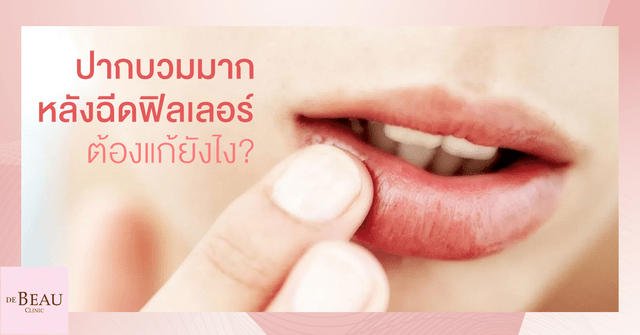 ปากบวมมากหลังฉีดฟิลเลอร์ ต้องแก้ยังไง?