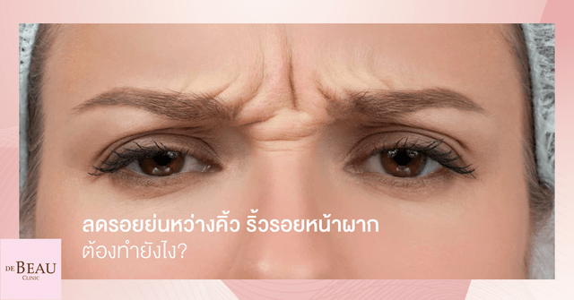 ลดรอยย่นหว่างคิ้ว ริ้วรอยหน้าผาก ทำยังไง?