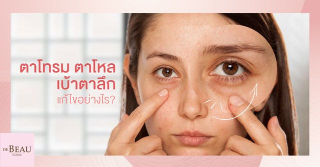 ตาโทรม ตาโหล เบ้าตาลึก ควรแก้ไขอย่างไร ใช้วิธีไหนดีที่สุด?