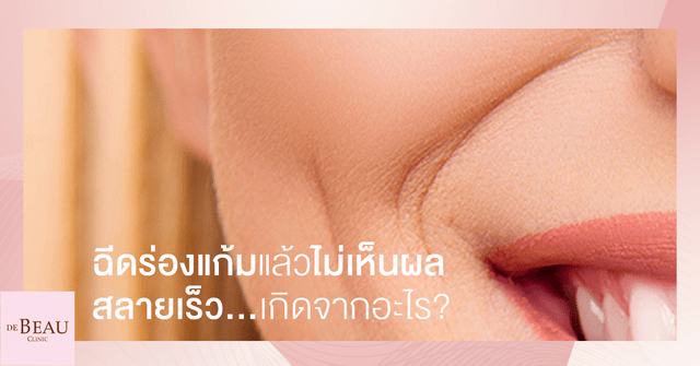 ฉีดร่องแก้มแล้วไม่เห็นผล สลายเร็ว เกิดจากอะไร?