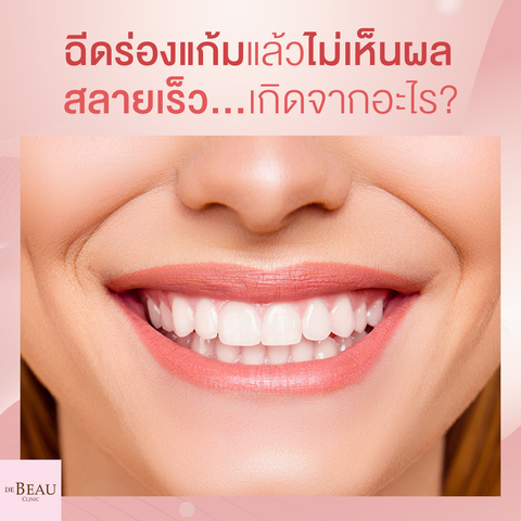 ฉีดร่องแก้มแล้วไม่เห็นผล สลายเร็ว เกิดจากอะไร?