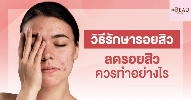 วิธีรักษารอยสิว ลดรอยสิว กู้ใบหน้าใสเนียนควรทำอย่างไร