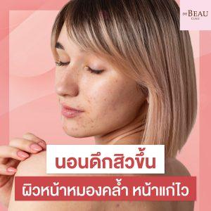 นอนดึกสิวขึ้น