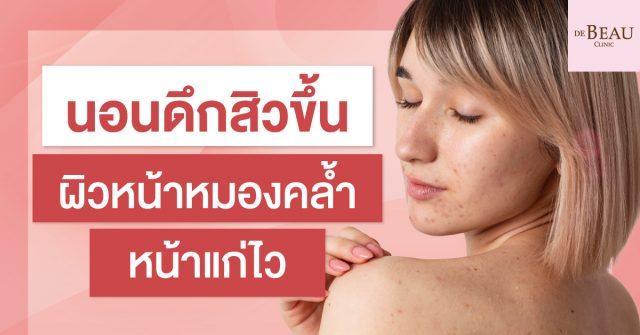 นอนดึกสิวขึ้น