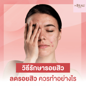 วิธีรักษารอยสิว ลดรอยสิว กู้ใบหน้าใสเนียนควรทำอย่างไร