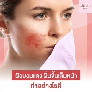 ผิวบวมแดง ผื่นขึ้นเต็มหน้า ทำอย่างไรดี