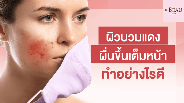 ผิวบวมแดง ผื่นขึ้นเต็มหน้า ทำอย่างไรดี